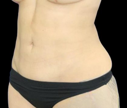 Liposuction Before & After Patient #875