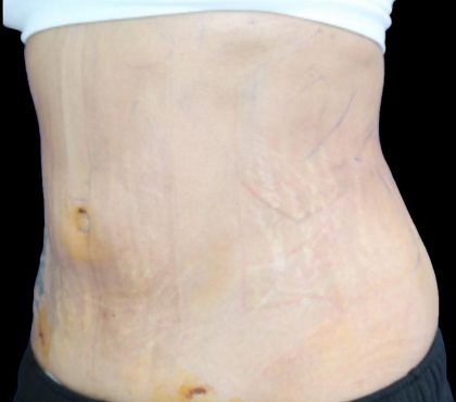 Liposuction Before & After Patient #876