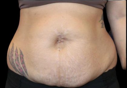 Liposuction Before & After Patient #877