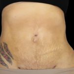 Liposuction Before & After Patient #877