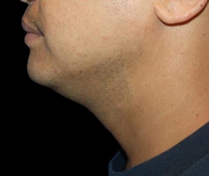 Neck Liposuction Before & After Patient #1035