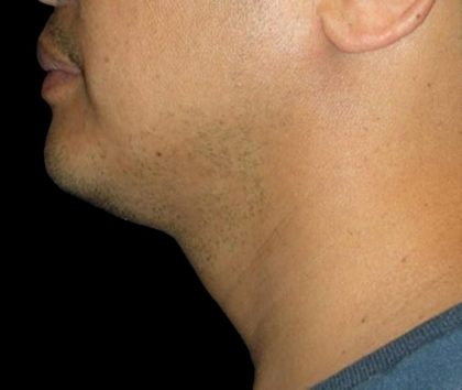 Neck Liposuction Before & After Patient #1035