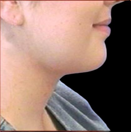 Neck Liposuction Before & After Patient #1039