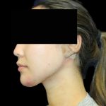Neck Liposuction Before & After Patient #1041
