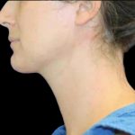 Neck Liposuction Before & After Patient #1042