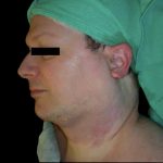 Neck Liposuction Before & After Patient #1043