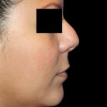 Rhinoplasty Before & After Patient #1046