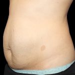 Tummy Tuck Before & After Patient #722