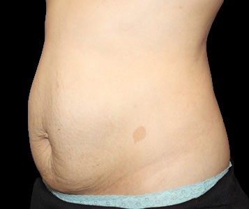 Tummy Tuck Before & After Patient #722