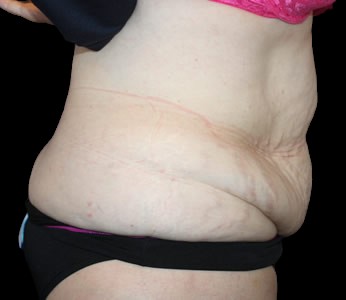 Tummy Tuck Before & After Patient #723