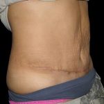 Tummy Tuck Before & After Patient #724