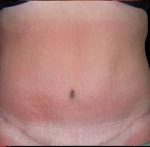 Tummy Tuck Before & After Patient #726