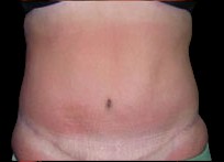 Tummy Tuck Before & After Patient #726