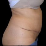 Tummy Tuck Before & After Patient #727