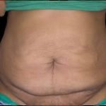 Tummy Tuck Before & After Patient #734