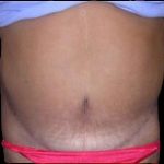Tummy Tuck Before & After Patient #735