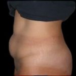 Tummy Tuck Before & After Patient #736