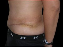Tummy Tuck Before & After Patient #736