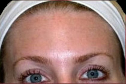 BOTOX® Before & After Patient #1169