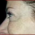 BOTOX® Before & After Patient #1171