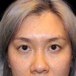 Blepharoplasty Before & After Patient #2478