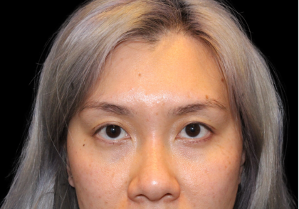 Blepharoplasty Before & After Patient #2478