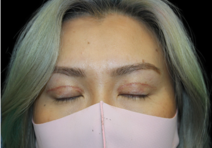 Blepharoplasty Before & After Patient #2478