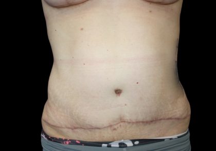 Tummy Tuck Before & After Patient #2858