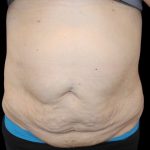 Tummy Tuck Before & After Patient #2858