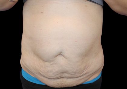 Tummy Tuck Before & After Patient #2858