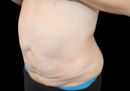 Tummy Tuck Before & After Patient #2858