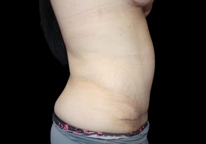 Tummy Tuck Before & After Patient #2858