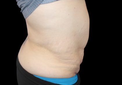 Tummy Tuck Before & After Patient #2858