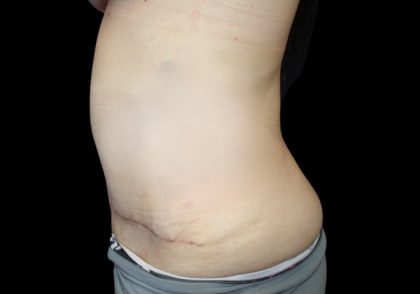 Tummy Tuck Before & After Patient #2858