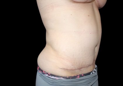 Tummy Tuck Before & After Patient #2858