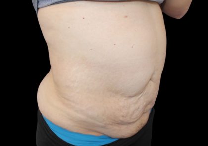 Tummy Tuck Before & After Patient #2858