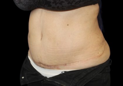 Tummy Tuck Before & After Patient #2869