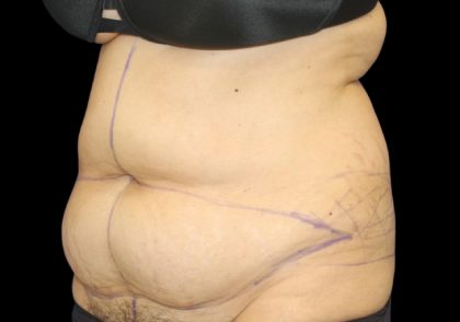 Tummy Tuck Before & After Patient #2869