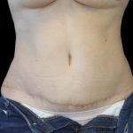 Tummy Tuck Before & After Patient #2869