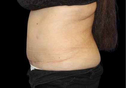 Tummy Tuck Before & After Patient #2869