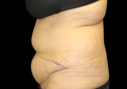 Tummy Tuck Before & After Patient #2869