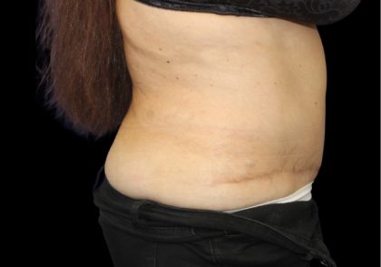 Tummy Tuck Before & After Patient #2869