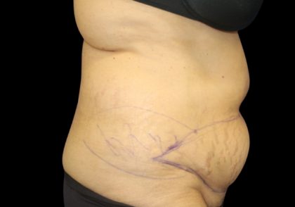 Tummy Tuck Before & After Patient #2869