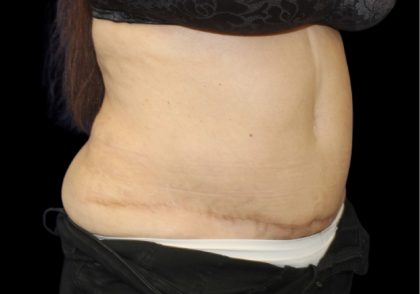 Tummy Tuck Before & After Patient #2869