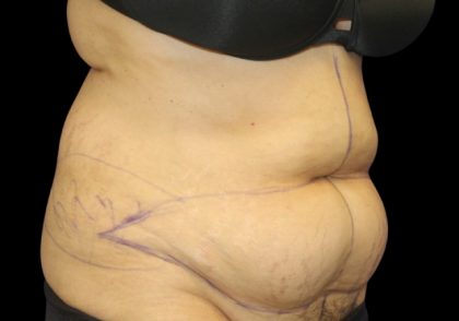 Tummy Tuck Before & After Patient #2869