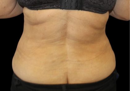 Tummy Tuck Before & After Patient #2869