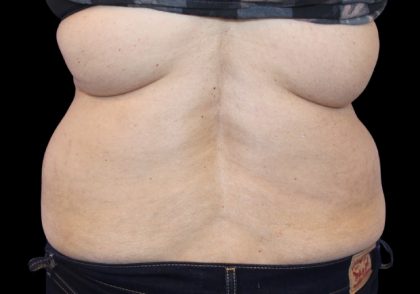 Tummy Tuck Before & After Patient #2869