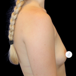 Breast Augmentation (Silicone) Before & After Patient #2453