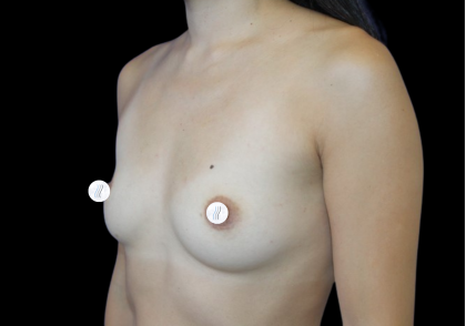 Breast Augmentation (Silicone) Before & After Patient #2464