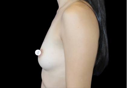 Breast Augmentation (Silicone) Before & After Patient #2464